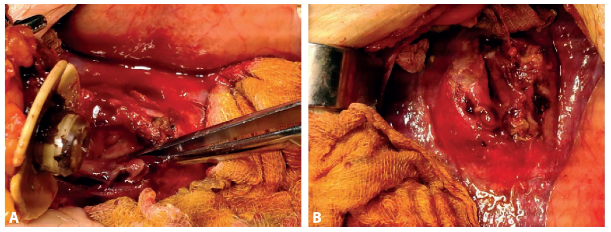Peroperačný nález dislokovaného PEG do S2 heparu (a) s abscesovou dutinou (b)<br>
Fig. 2. Peroperative fi nding of dislocated PEG to S2 of the liver (a) with abscess cavity (b)