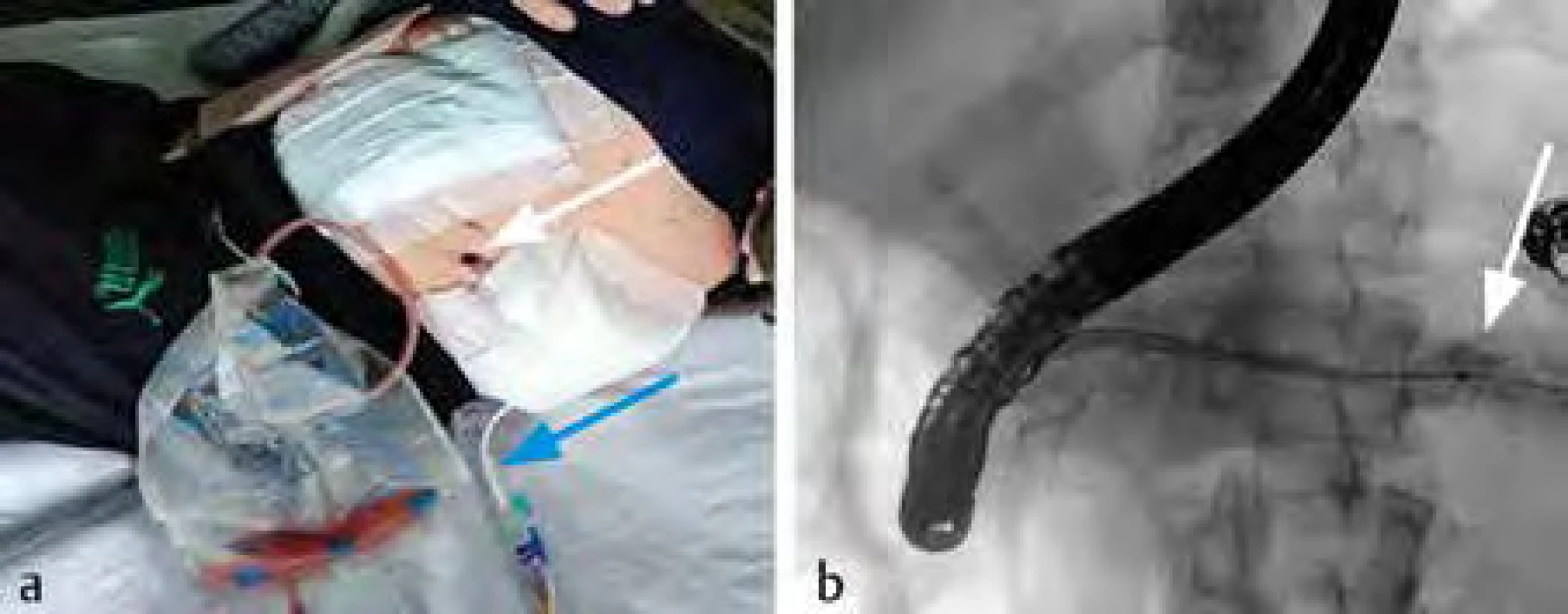 a) Po provedení VARD (videoasistovaný retroperitoneální débridement) vznikla jako komplikace píštěl
ocasu pankreatu (bílá šipka ukazuje na kanál VARD), modrá šipka ukazuje na odlehčovací drenáž píštěle ocasu
pankreatu); b) zobrazení píštěle ocasu pankreatu pomocí endoskopické retrográdní cholangiopankreatikografie
(ERCP) (bílá šipka ukazuje na únik kontrastní látky v okolí ocasu pankreatu)