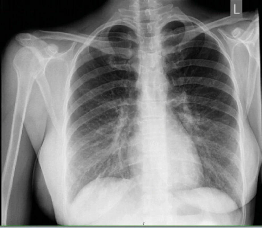 RTG hrudníka – akcentovaná bronchovaskulárna kresba v dolnom 
pľúcnom poli bilaterálne