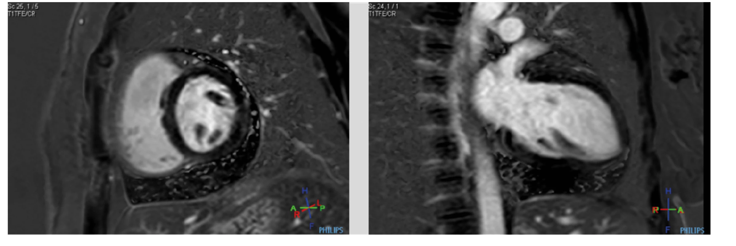 (a, b). MRI srdce. Pozdní postkontrastní sekvence ve vertikální dlouhé ose (dvoudutinová projekce) a krátké ose: perikardiální listy bez průkazu
pozdního sycení gadoliniovou kontrastní látkou