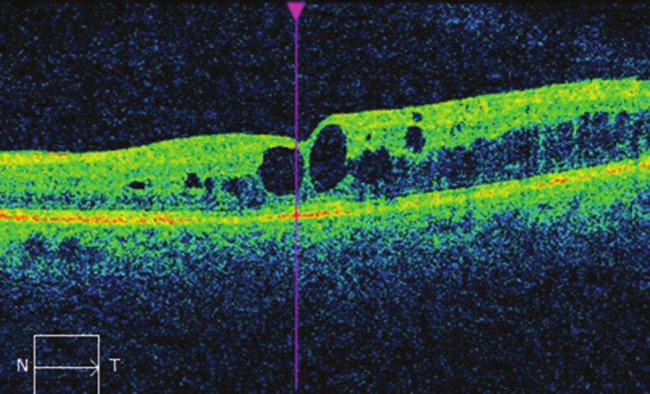 Nález na OCT na levém oku před léčbou mikropulzním laserem:
cystoidní makulární edém, CRT 395 μm.