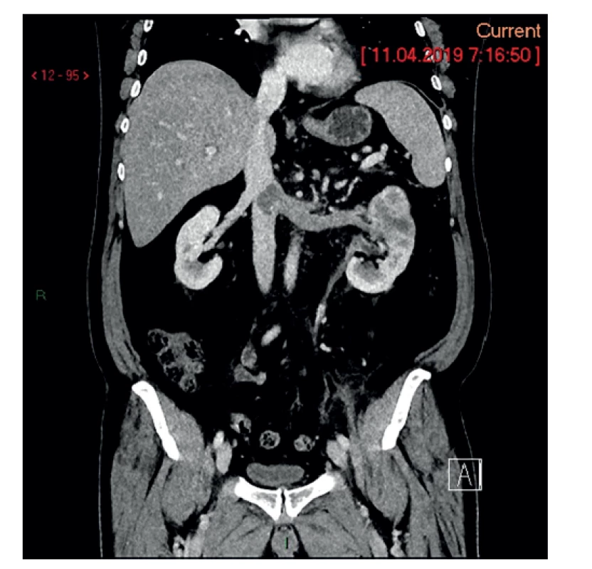 Ľavá oblička s nádorom a v. renalis s nádorovým
trombom zasahujúcim do VCI<br>
Fig. 8: Left kidney with tumor and v. renalis with a tumor
thrombus extending into VCI