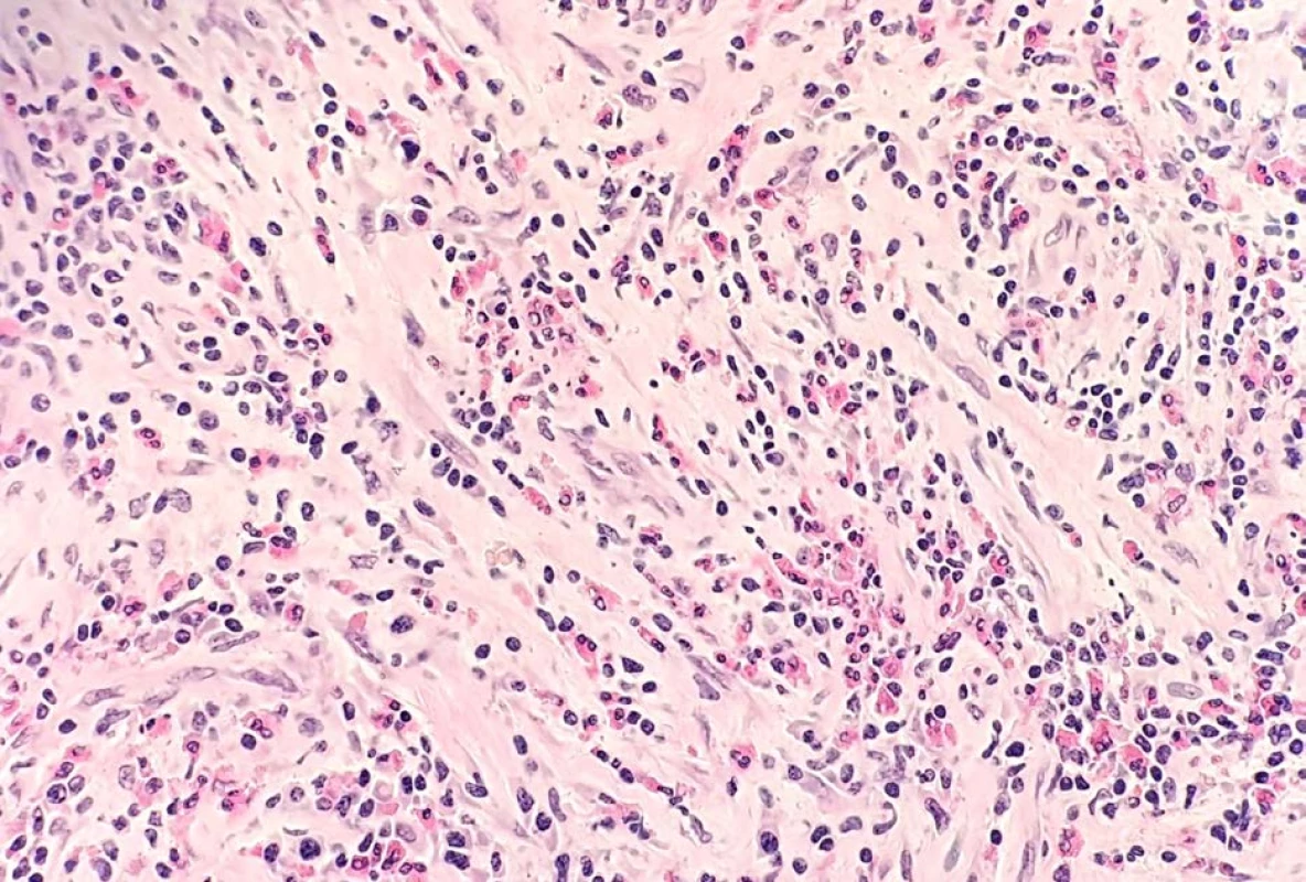 Detail eosionofilní funkilutidy (hematoxyilin-eosin, 200x)<br>
Fig. 3. Detail of eosinophilic funiculitis (hemathoxylin-eosin, 200x)