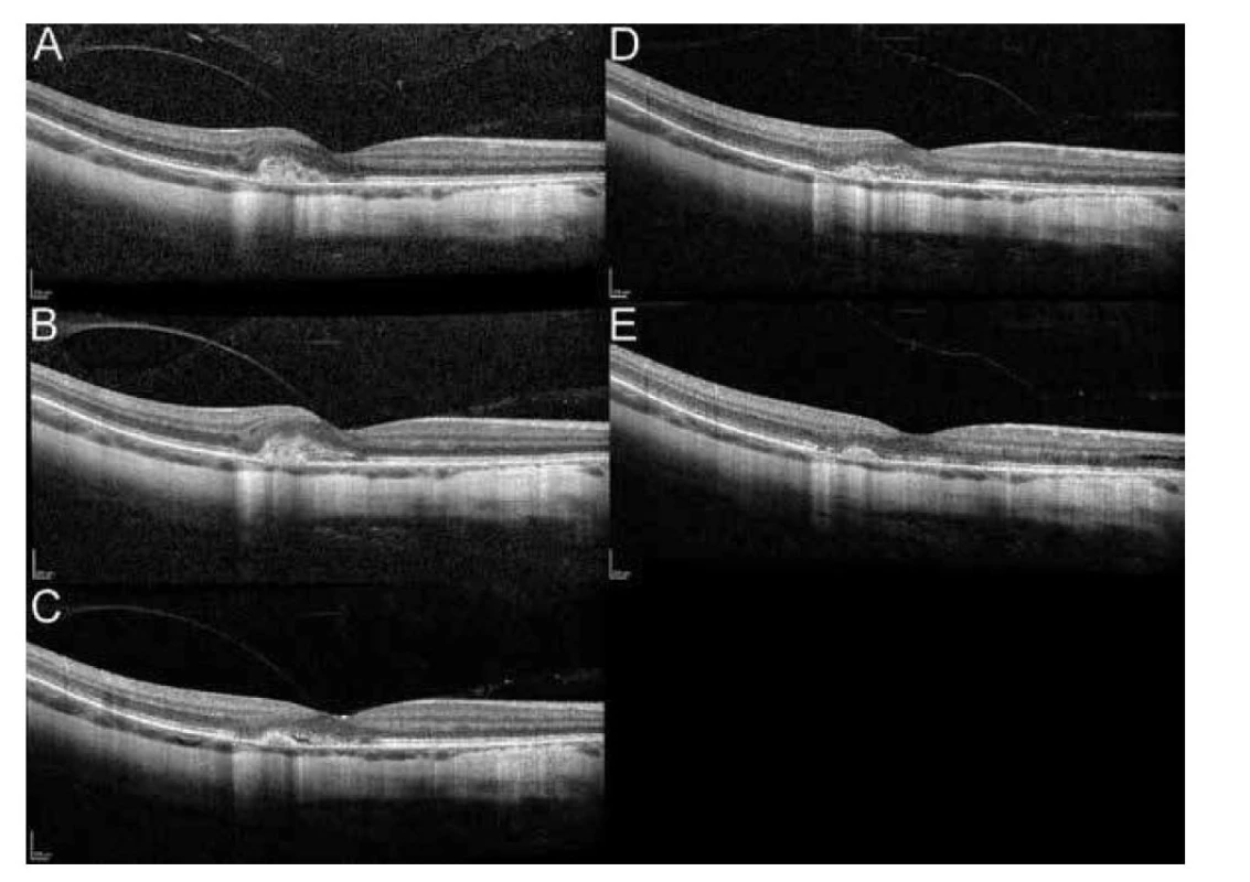 Optická koherenční tomografie makuly pravého oka.<br>
A) Vstupní nález, patrné hyperreflektivní ložisko v oblasti makuly nad retinálním pigmentovým epitelem, nejlepší
korigovaná zraková ostrost (NKZO) 68 písmen ETDRS optotypů, centrální retinální tloušťka (CRT) 310 μm.<br>
B) Nález po 14 dnech od vstupu, patrný nárůst ložiska a edému v makule, NKZO 68 písmen ETDRS optotypů, CRT
329 μm.<br>
C) Nález 3 týdny po aplikaci ranibizumabu, NKZO 78 písmen ETDRS optotypů, CRT 276 μm.<br>
D) Reaktivace myopické neovaskulární membrány, NKZO 72 písmen ETDRS optotypů, CRT 309 μm.<br>
E) Stav po 2. aplikaci ranibizumabu, NKZO 79 písmen ETDRS optotypů, CRT 264 μm.