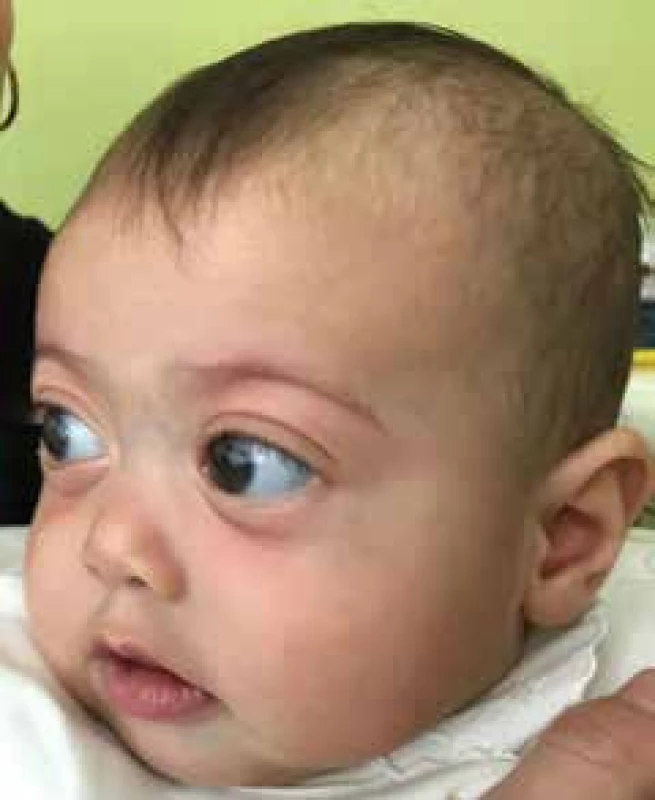 Central
facial dysmorphia,
shallow
orbits, pseudoexophthalmos,
hypertelorism
and low root of
nose in patient
with Marshall/
Stickler syndrome
at age of 4
months.