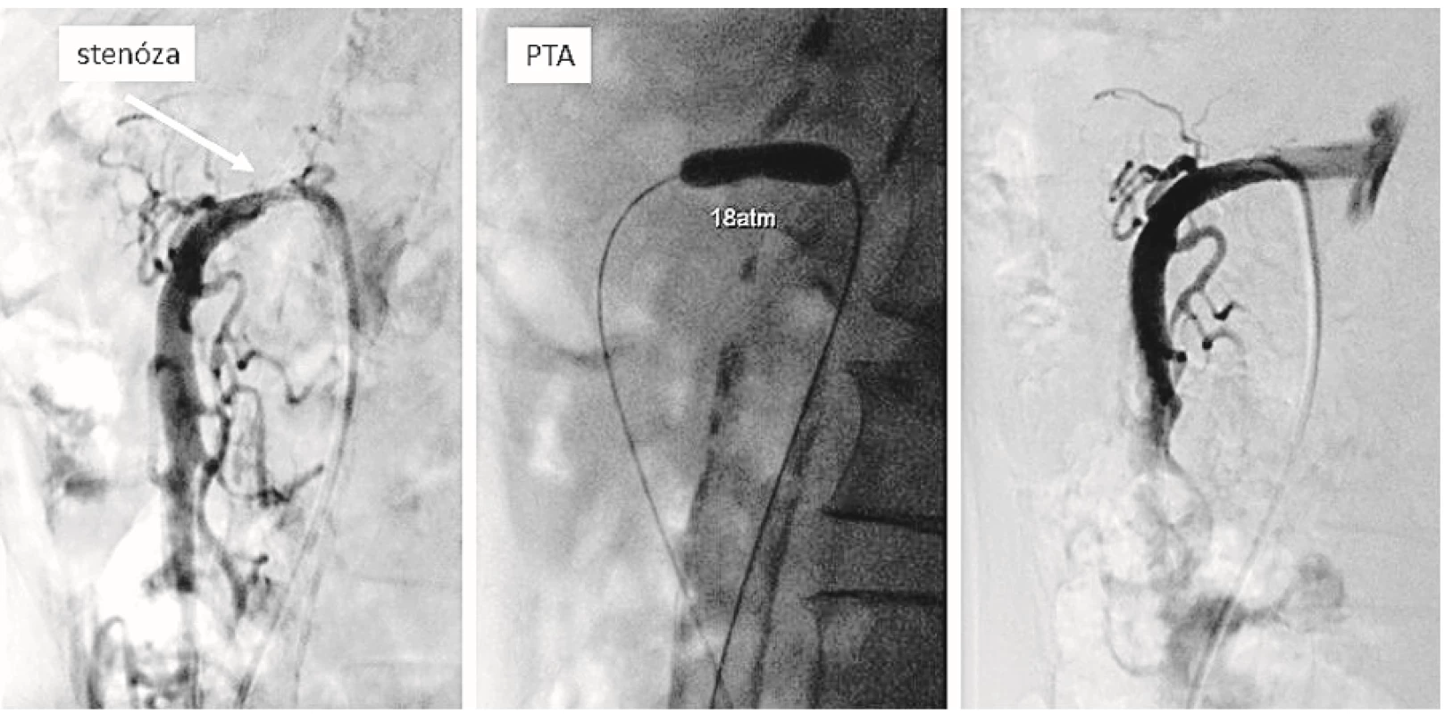 Angiografie a. mesenterica superior s patrnou stenózou v odstupu (levá část), průběh PTA odstupové stenózy – použit tlak  18 atm (střední část), úspěšný výsledek PTA bez reziduální stenózy (pravá část)