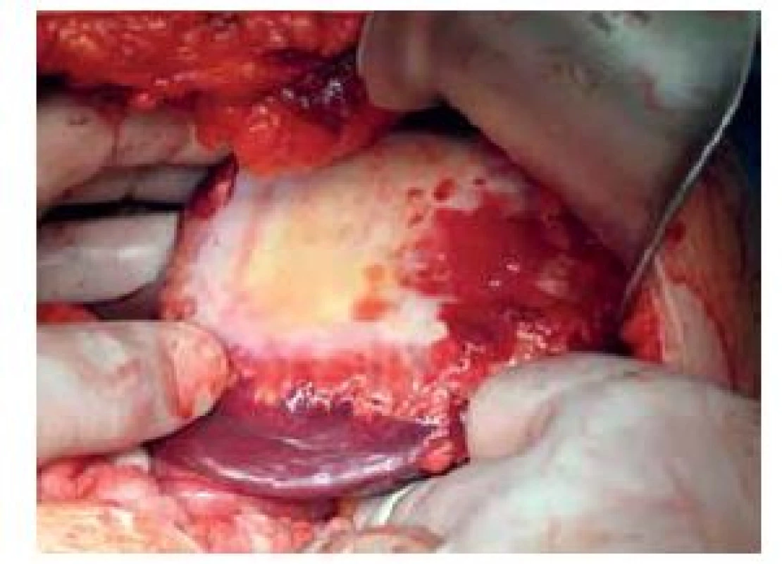 Findings during surgical intervention – cyst in the
left liver lobe
