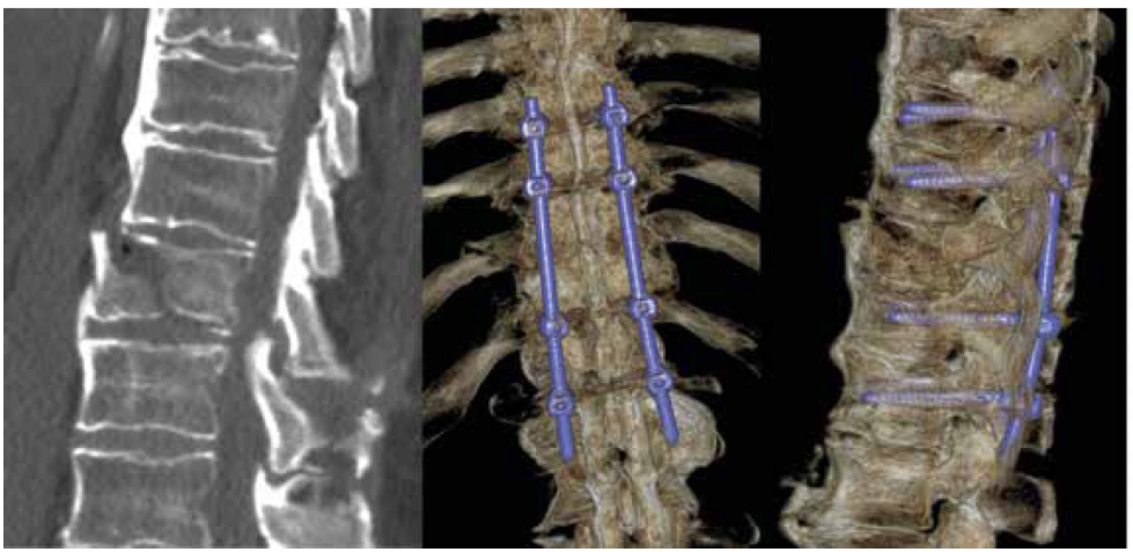 Zlomenina Th10 u pacienta s DISH (M2) mechanismem hyperextenze s poranění předního závěsného
aparátu (B3) bez neurologické léze (N0) TL AOSIS – 7, řešena dlouhou transpedikulární instrumentací
ze zadního přístupu<br>
Fig. 2. Fracture of Th10 in DISH patient (M2) with anterior tension band injury from hyperextension (B3),
without neurological deficit (N0) TL AOSIS – 7, treated by posterior transpedicular long instrumentation