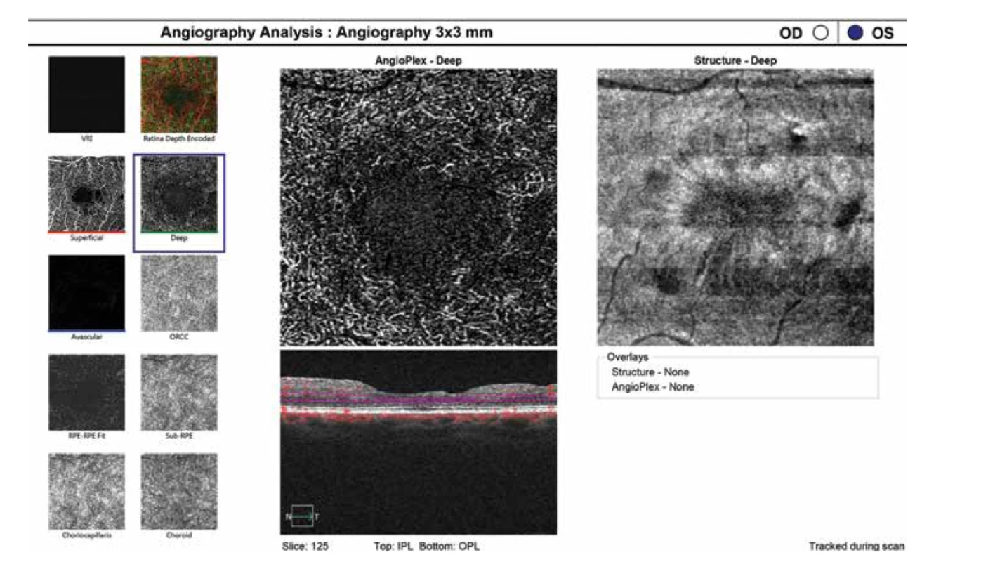 Hluboký kapilární plexus v OCTA obraze, strukturální en face snímek a OCT B scan u stejné pacientky po operaci