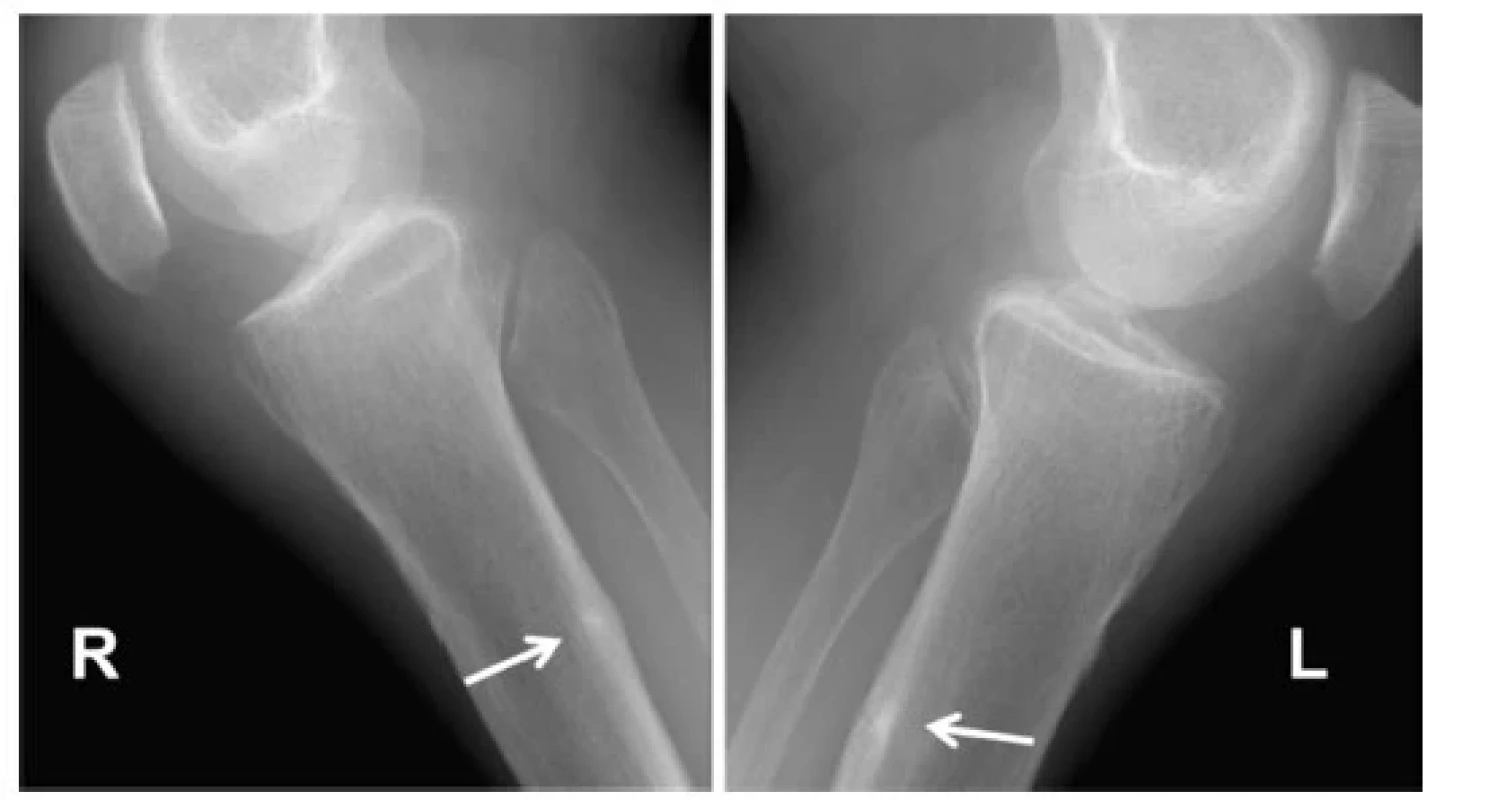Looserovy zóny kostní přestavby obou bérců u pacienta s dekompenzovanou
Bylerovou chorobou (progresivní familiární intrahepatální
cholestáza). Chronická malabsorpce vedoucí k osteomalacii