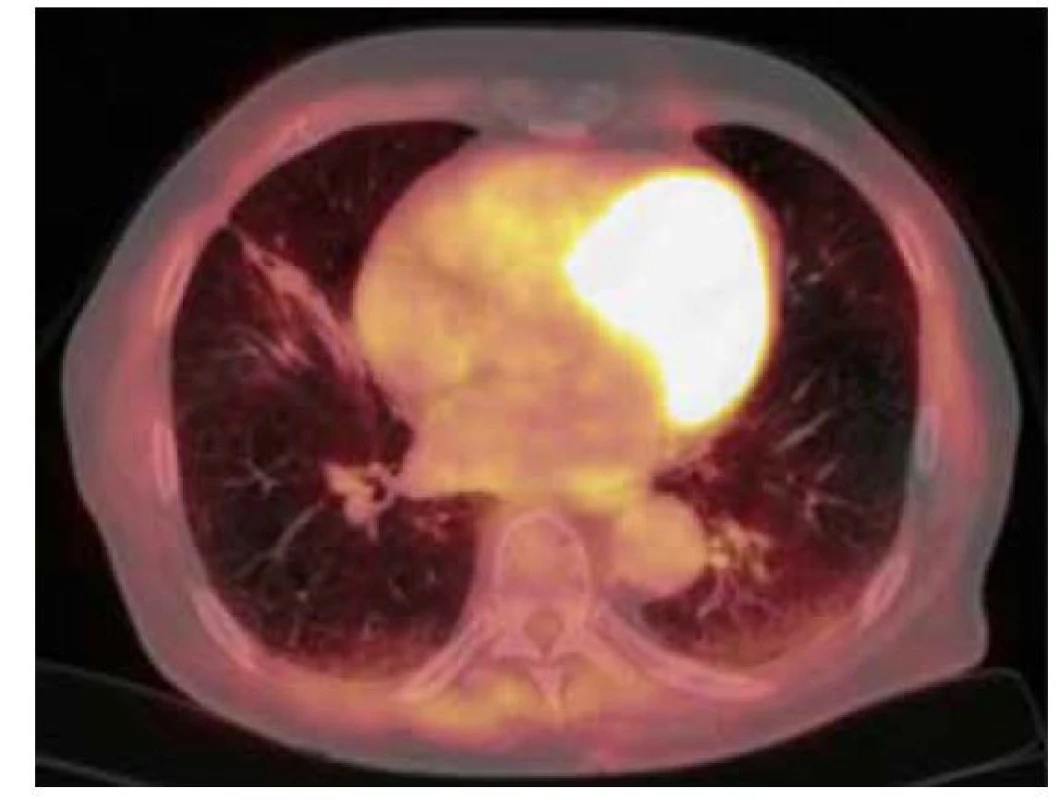 18F-FDG PET/CT vyšetření hrudníku po resekci ložiska – zobrazují
se pouze pooperační změny v pravé plíci