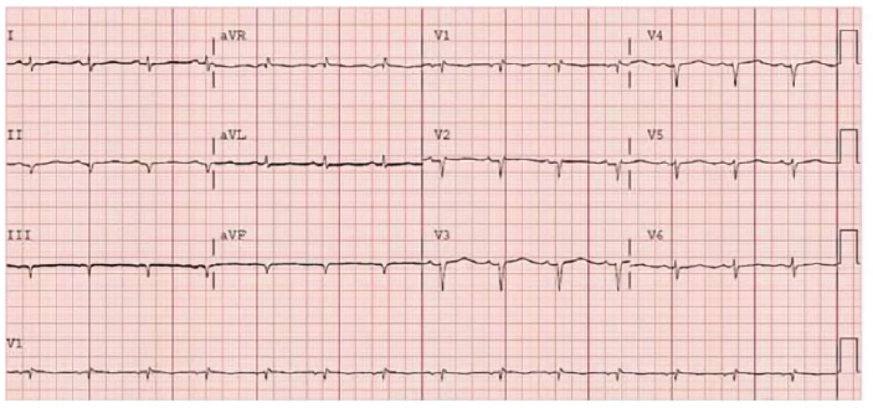 EKG křivka nemocného se srdeční amyloidózou. Patrná je nízká voltáž QRS komplexů a pseudoinfarktové změny