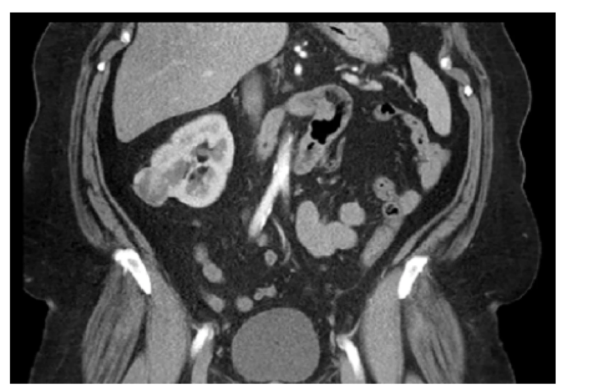 CT, koronární řez. Tumor pravé ledviny cT1a
(34 mm) RENAL skóre 5×, vlevo ageneze ledviny.
BMI 42. Řešeno laparoskopickou resekcí s nulovou
ischemií<br>
Fig. 2. CT scan, coronal plane. The tumor of the right
kidney cT1a (34 mm) RENAL score 5×, agenesis of the
left kidney. BMI 42. Laparoscopic partial nephrectomy
with zero ischemia time was performed