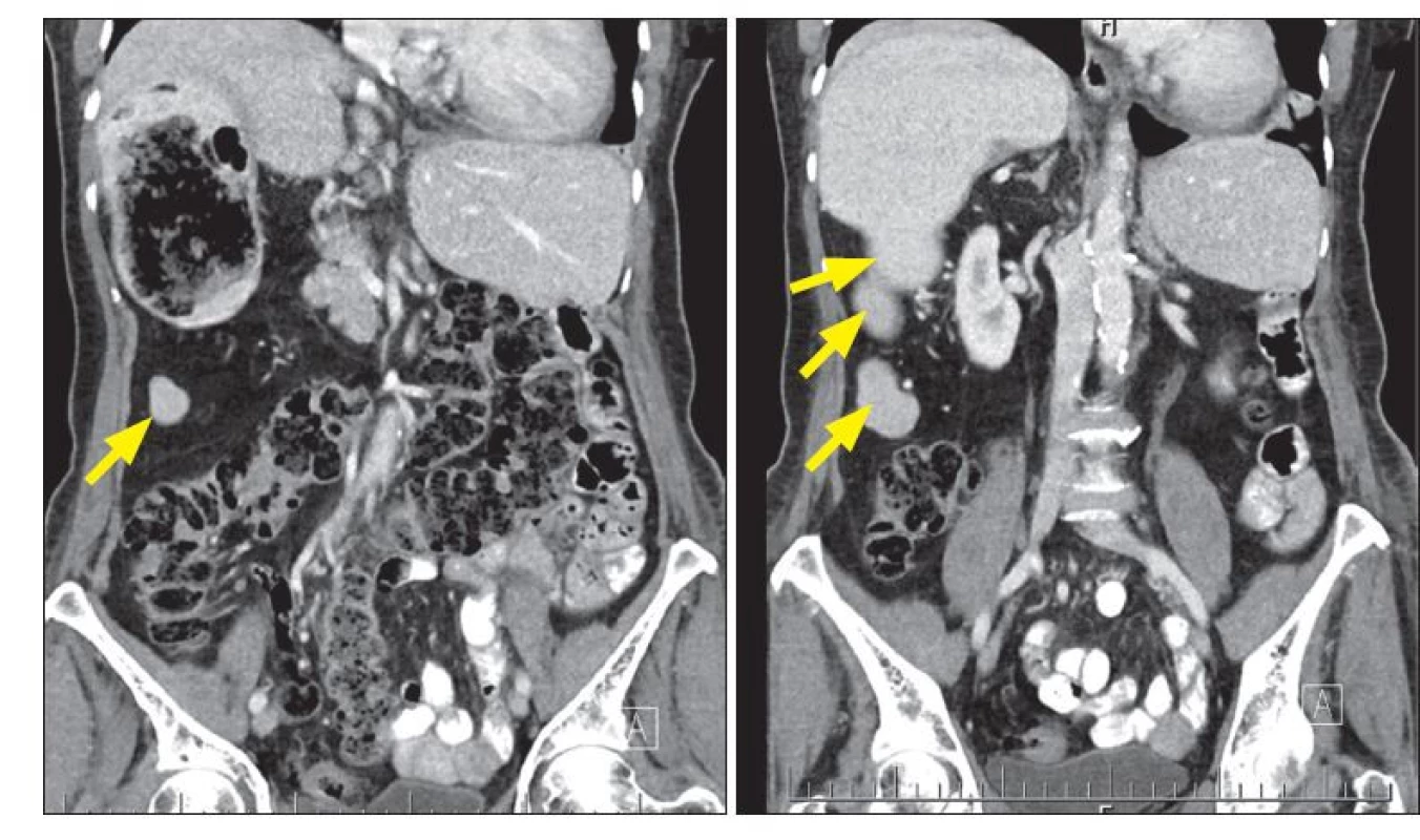 Obr. 6, 7 CT vyšetření břicha a malé pánve: inverzní uložení orgánů, fragmentovaná slezinná tkáň v pravém
hypochondriu (šipky).