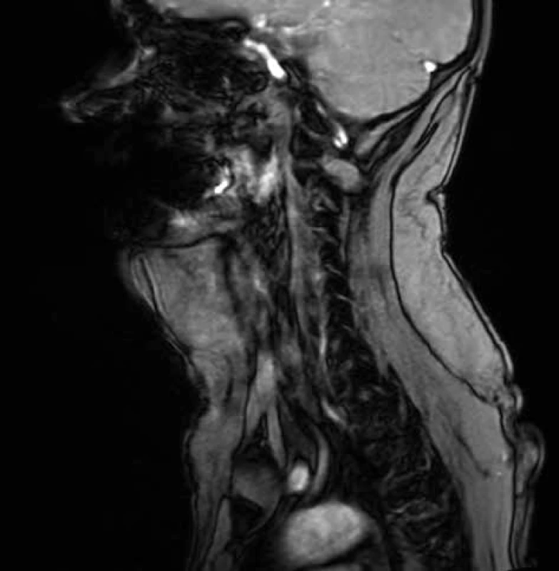 MRI krku s ventrálně uloženým lipomem<br>
Fig. 5: MRI of neck with ventrally deposited lipoma