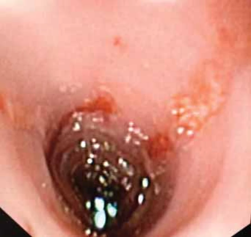 A. Endoscopic imaging – view of distal esophagus.
Ulceration covered by mucus, mucosa fragile to the touch,
contact bleeding.<br>
Obr. 1A. Endoskopický obraz – pohled na distální jícen.
Ulcerace kryté hlenem, sliznice kâehká na dotek, kontaktně
krvácející.
