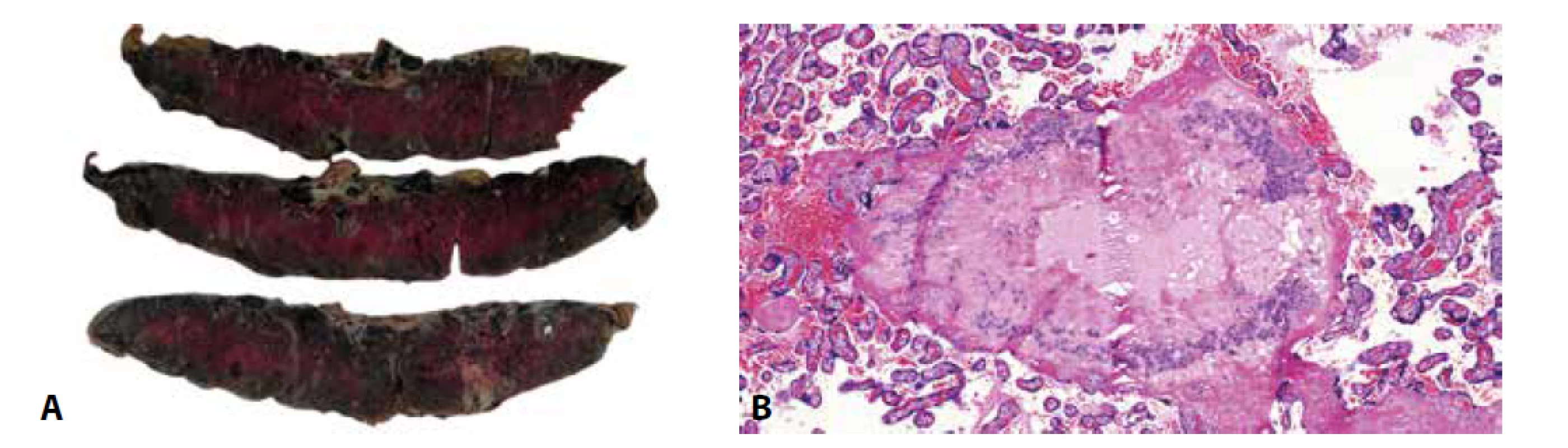 A: Mnohočetné cysty EVT. B: Cysta EVT. Eozinofilní materiál v centru cystické léze obklopený buňkami extravilózního trofoblastu (HE, 100x).