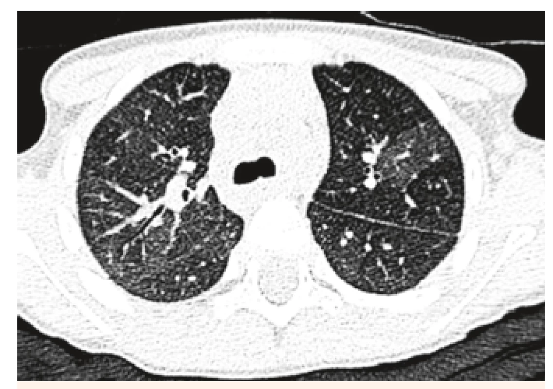 HRCT pľúc u našej 4-ročnej pacientky, mozaikovitá
perfúzia pľúc ako známka intersticiálneho postihnutia.<br>
Fig. 3. HRCT examination of lung in our 4-year patient, mosaic
lung perfusion as a sign of interstitial disability.