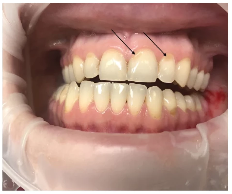 Zubní eroze – lokalizace
erozivních lézí závisí na zdroji
kyselin vyvolávajících dané
defekty (označené černou
šipkou) <br> 
Fig. 3.
Dental erosion – the location of
erosive lesions depends on the
sources of acids causing the
defects (black arrow)