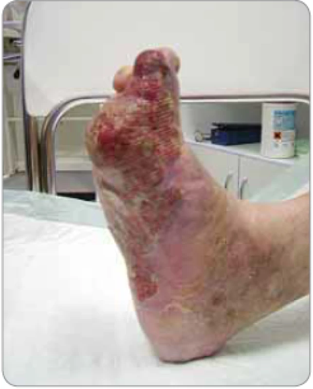 Bolestivé tumorózní postižení nohy pacienta (vč. plosky) – pacient nemohl stát.
