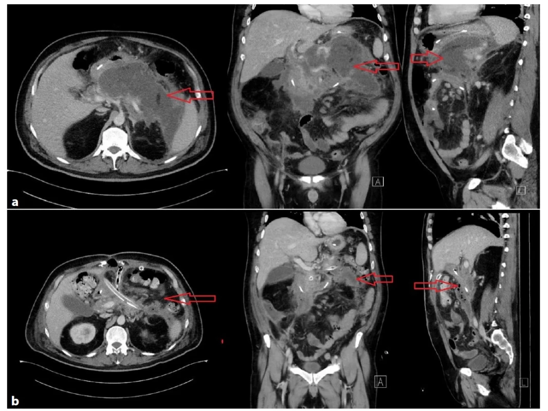 a−3b: Těžký průběh akutní biliární pankreatitidy s nekrózou >50 % pankreatu u 44letého muže<br>
Obraz nekrotizující pankreatitidy, vícečetné septované tekutinové porce 190×90×160 mm, nález nevhodný k perkutánní či transgastrické
drenáži (Obr. 3a), indikována otevřená chirurgická revize, drenáž, open abdomen, dle CT patrná výrazná regrese nálezu
(Obr. 3b). Délka hospitalizace 122 dní, ventilován 15 hodin.<br>
Fig. 3a−3b: Severe course of acute biliary pancreatitis with pancreatic necrosis of more than 50% of pancreatic tissue in
a 44-year-old man<br>
Necrotizing pancreatitis, multiple septated fluid portions 190×90×160 mm unsuitable for percutaneous or transgastric drainage
(Fig. 3a). Open surgical revision, drainage and open abdomen were indicated. There was a significant regression of the collections
on the control CT scan (Fig. 3b). Hospital stay was 122 days; the patient was ventilated for 15 hours.