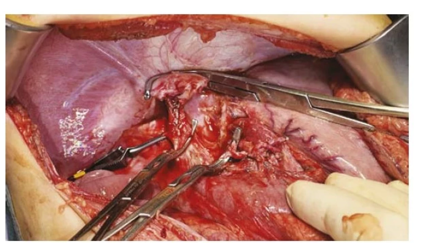 Anhepatická fáze během transplantace jater (dutina břišní
bez jater), svorky na jaterní tepně, portě, jaterních žilách