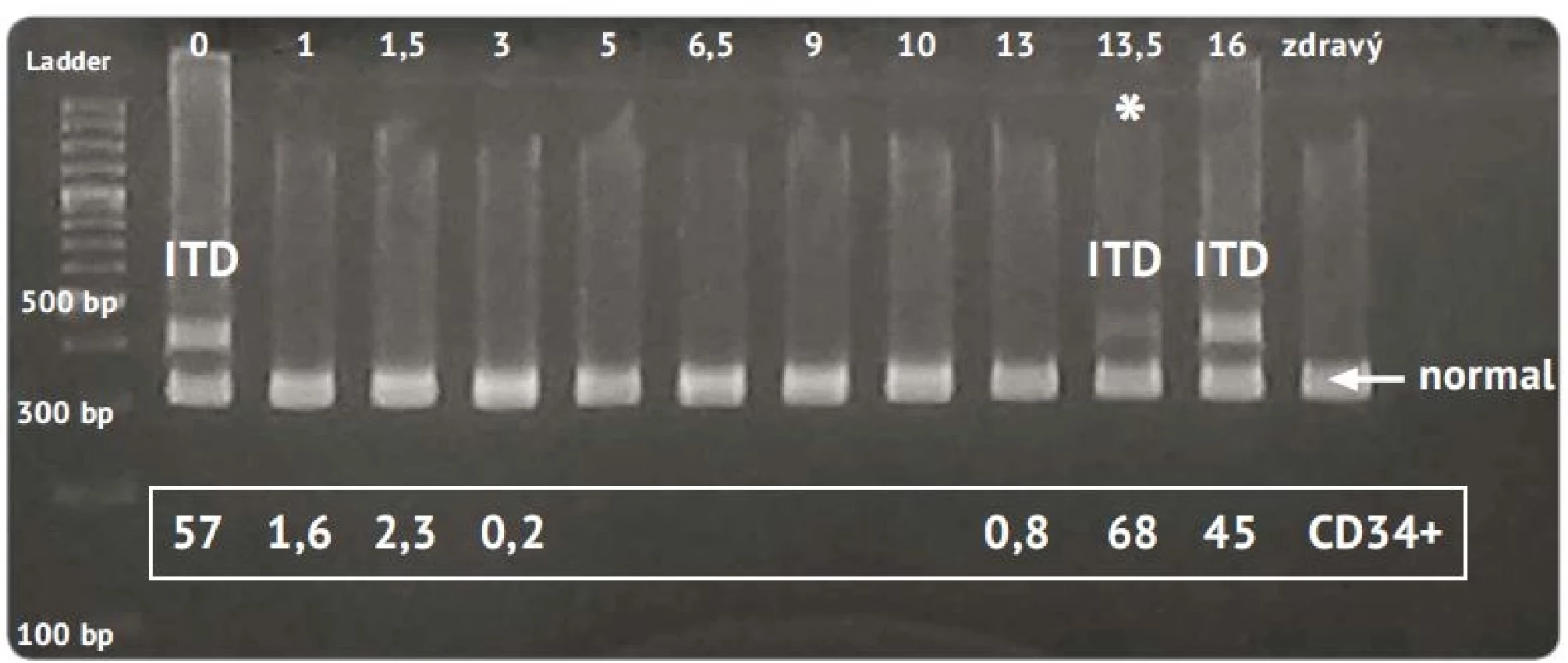 Elektroforeogram PCR fragmentov génu <i>FLT3</i> u pacienta s prechodom MDS do AML.