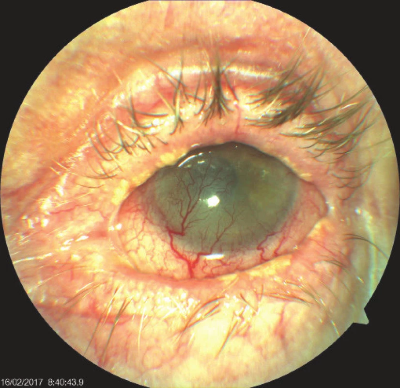 Left eye of patient with severe cicatrising blepharoconjunctivitis,
vascularised leucoma, on surface persistent
painful defect of corneal epithelium. Whitish plaques on
edges of eyelid suggestive of lichenoid lesions