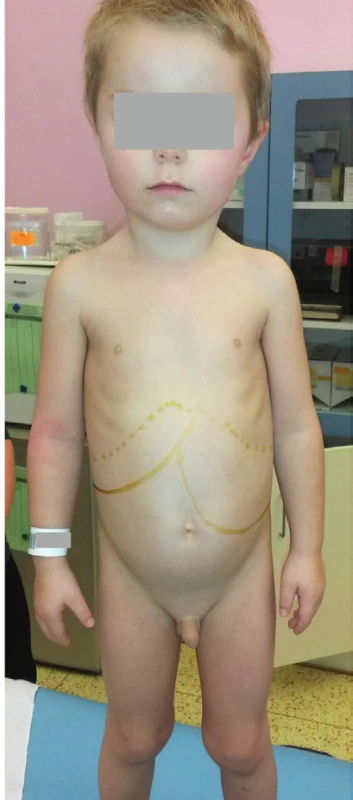 Hepatosplenomegalie
u 3,5letého chlapce
s Gaucherovou nemocí
typu I.<br>
Fig. 4. Hepatosplenomegaly in
3.5-year-old child with
Gaucher disease Type I.