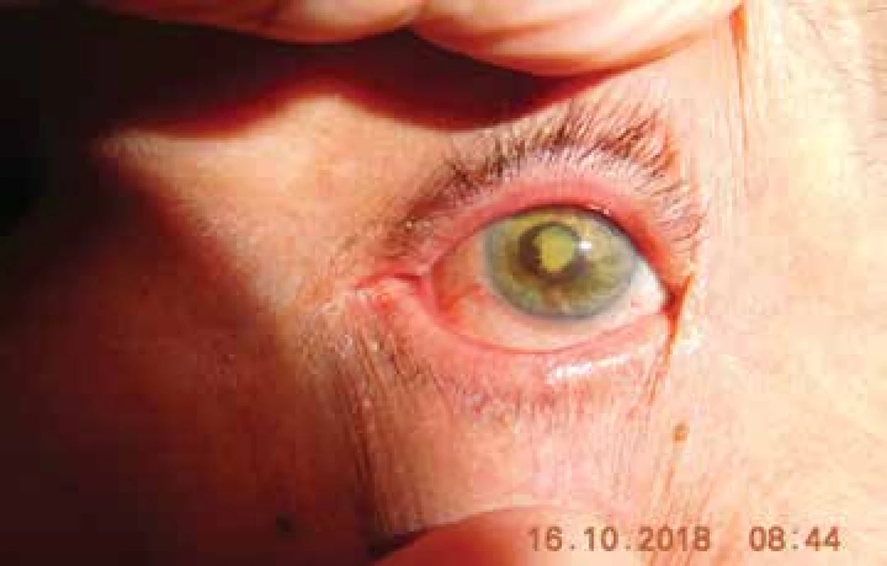Pacient s postradiačnou kataraktou a neovaskulárnym glaukómom