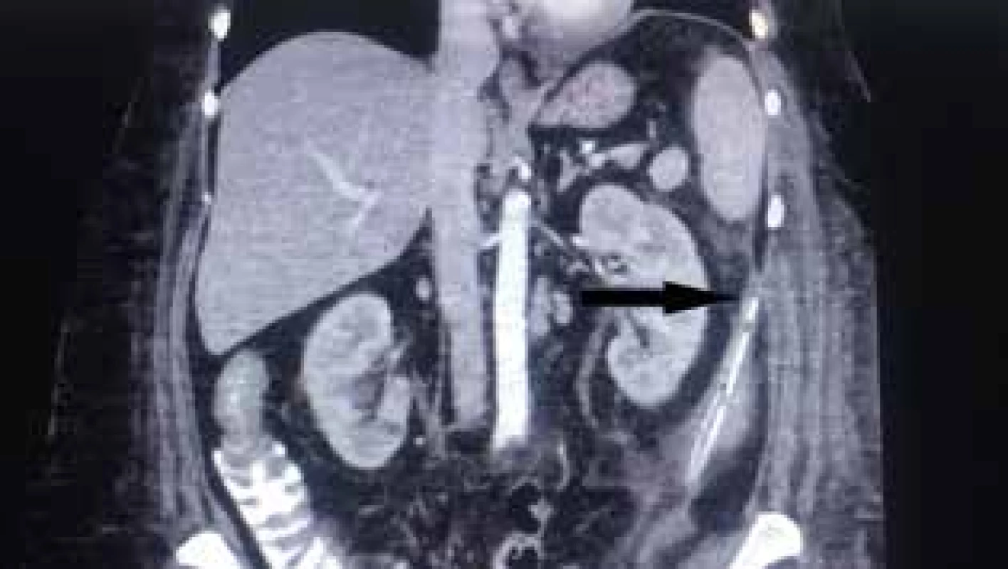 Koronární řez CT břicha s drénem v abscesové dutině <br>Fig. 4: Coronary abdominal CT scan with a drain in the abscess cavity