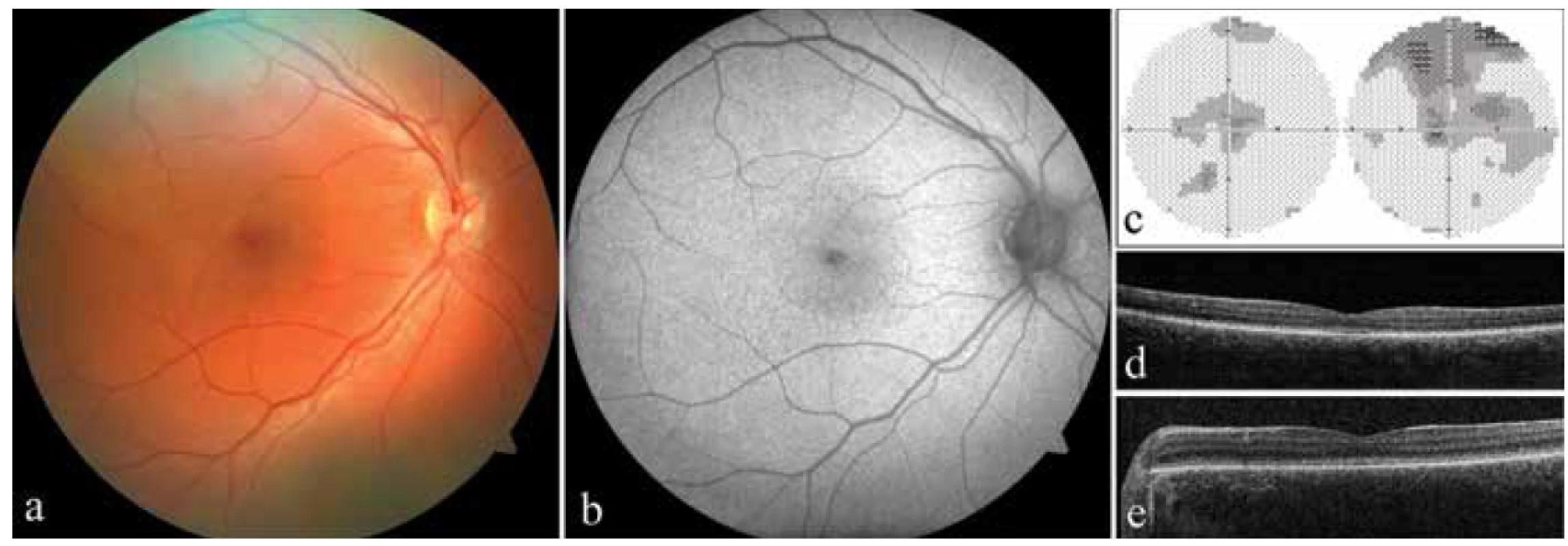 Klinický nález u obou probandů s achromatopsií. a) fotografie fundu pravého oka probanda 1, b) autofluorescence
fundu pravého oka probanda 1, c) perimetr pravého a levého oka probanda 1, d) optická koherenční tomografie se
spektrální doménou (SD-OCT) levého oka probanda 1, e) SD-OCT levého oka probanda 2