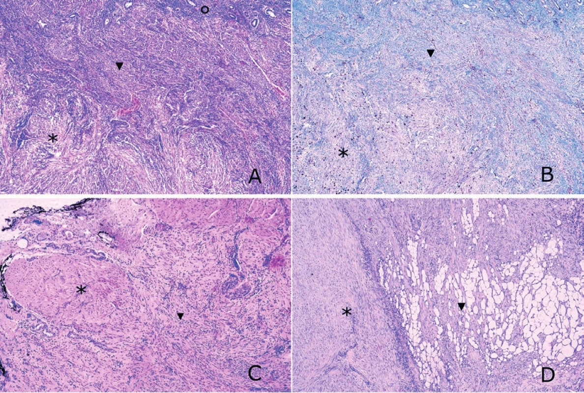 Histologický obraz a proliferační aktivita v disekujícím leiomyomu dělohy.<br>
A: Řez zachycující endometrium (), myometrium () a intramurální složku disekujícího leiomyomu () (barvení hematoxylin-eozin, zvětšeno
200x).<br>
B: Mírně vyšší proliferační aktivita Ki-67 v disekujícím leiomyomu () ve srovnání s přilehlým myometriem () (imunohistochemie, zvětšeno
200x).<br>
C: Svalová vrstva stěny ureteru () infiltrovaná extramurální složkou disekujícího leiomyomu () (barvení hematoxylin-eozin, zvětšeno 200x).<br>
D: Intramurální () i extramurální složka disekujícího leiomyomu s patrnou infiltrací tukové tkáně parametrií () (barvení hematoxylin-eozin,
zvětšeno 200x).