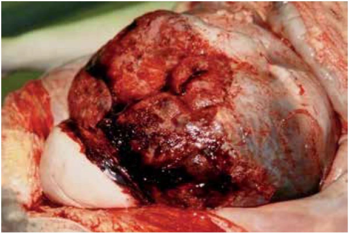 Trhlina tela maternice a plodové vajce v brušnej dutine.