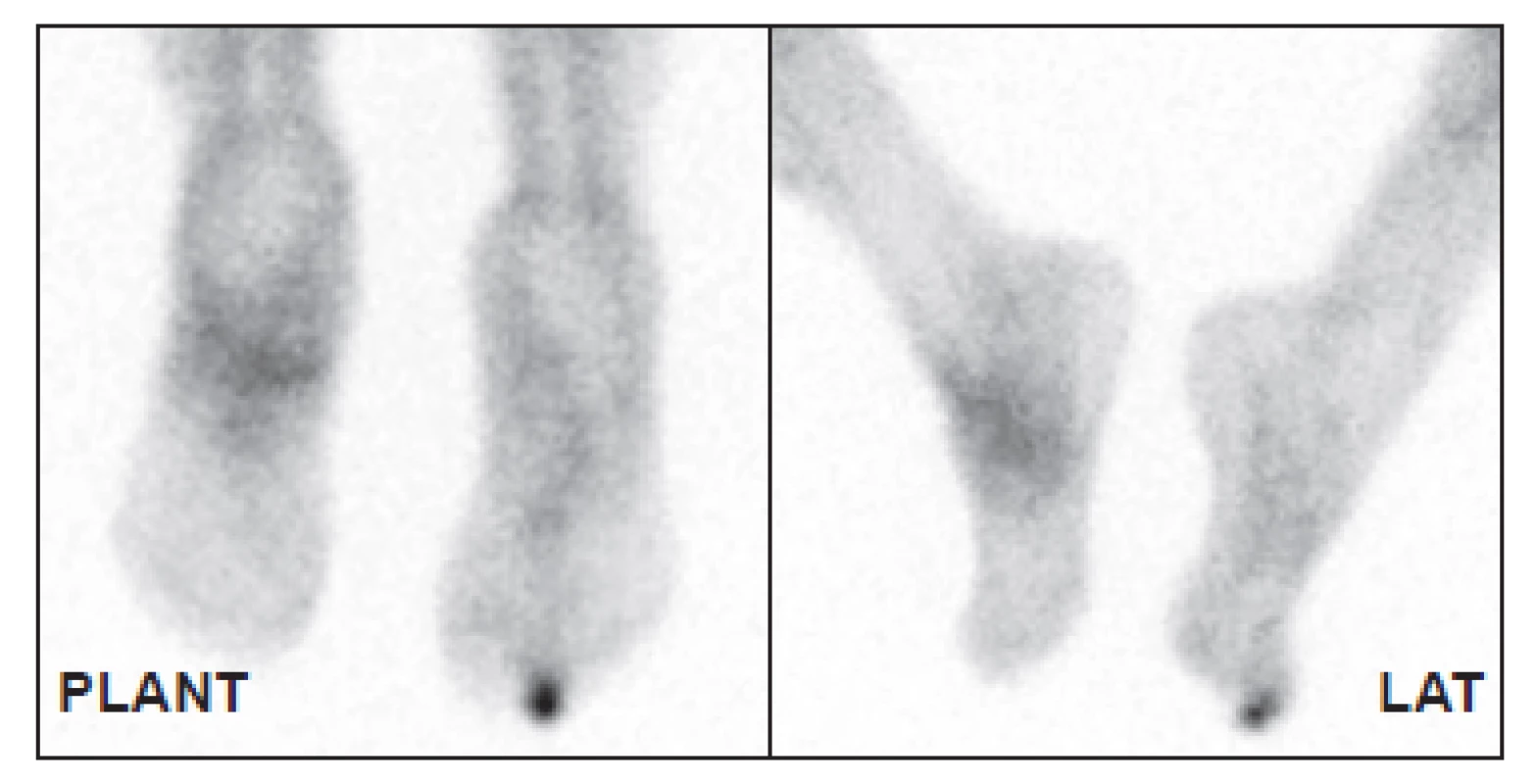Distribuce značených leukocytů za 4 hodiny po aplikaci. Kromě
nártu je patrná zvýšená akumulace také v prstu pravé nohy. Z obrázku
je jasně patrné, že samotná scintigrafie neobsahuje anatomickou
informaci, určení správného prstu tedy není pouze z obrazu možné.