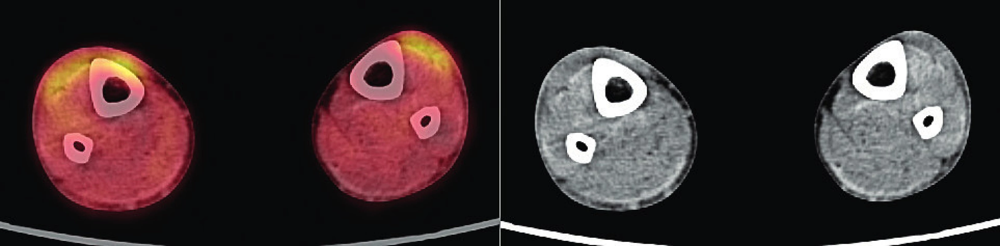 PET/CT zobrazení dolních končetin pacienta s xantogranulomem z roku 2019 – část 3