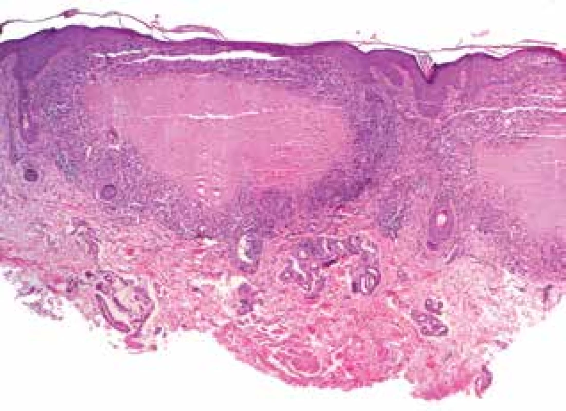 Lupus miliaris disseminatus faciei: kaseifikující granulomy
(HE 40x)