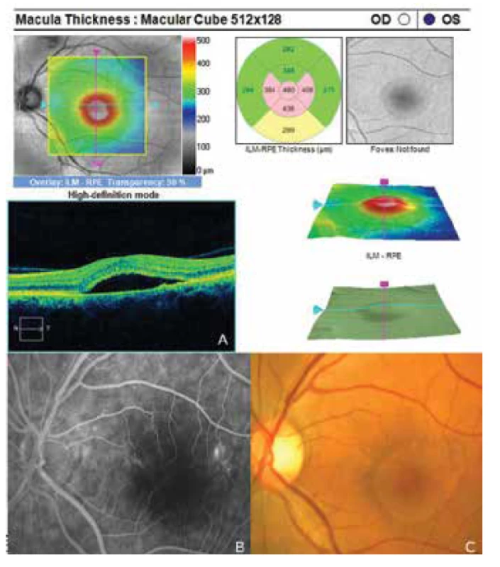 Známky centrální serózní chorioretinopatie levého oka