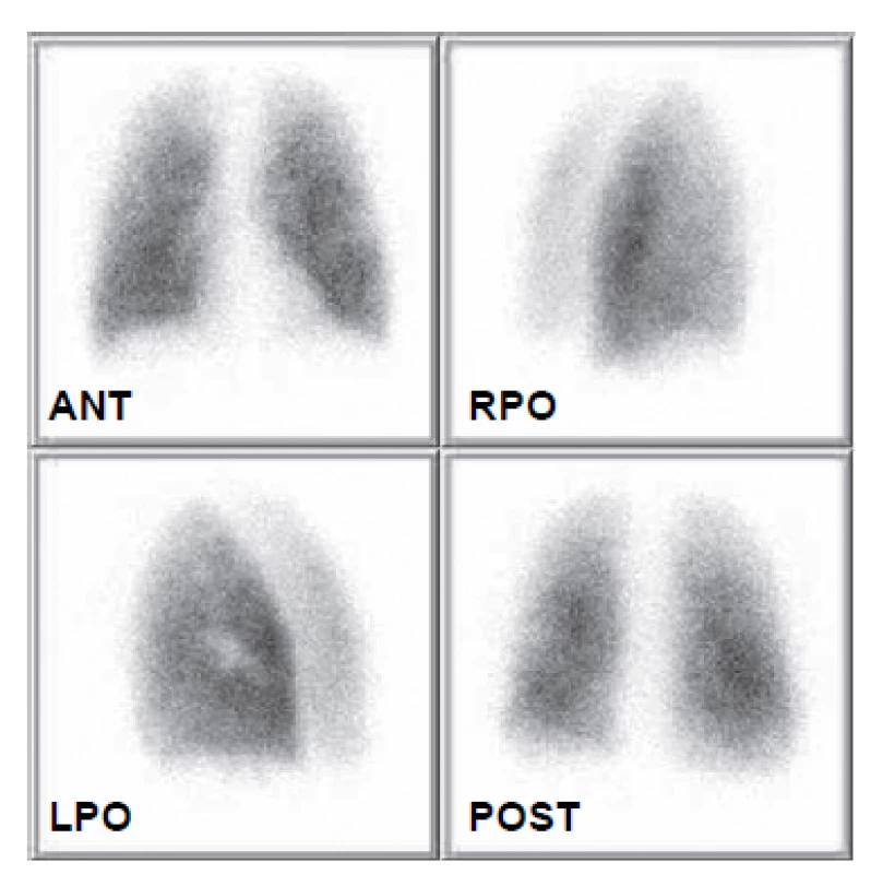 Obraz distribuce plicní perfuze na kontrolním vyšetření 17. 10.
2008 prokazuje kompletní rekanalizaci podobně jako při předchozí
atace.