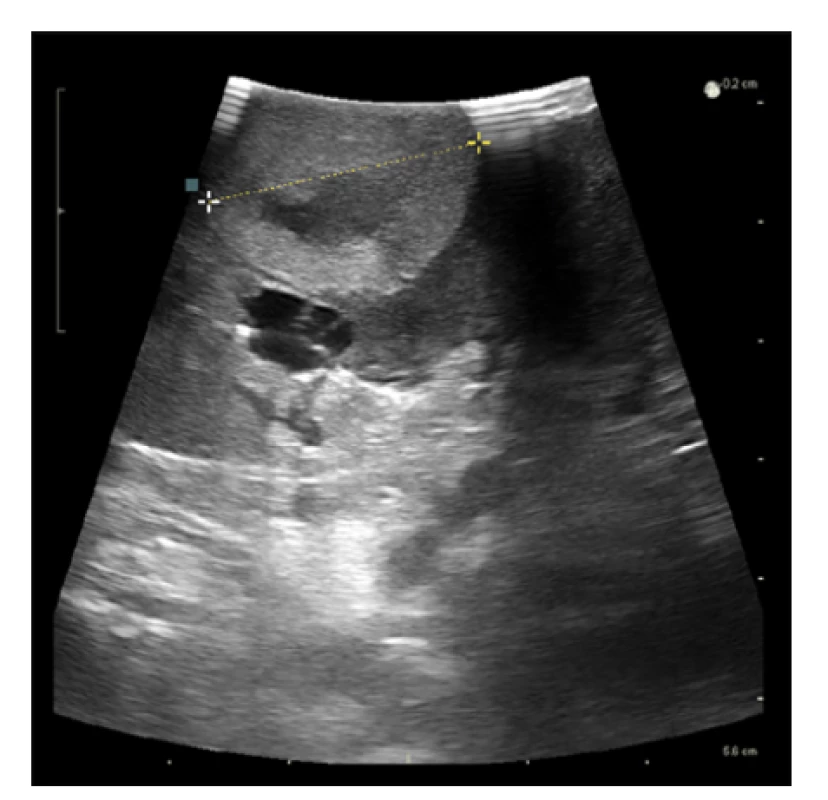 Využití perioperační ultrasonografie při laparoskopické
resekci tumoru solitární ledviny<br>
Fig. 3. The usage of perioperative ultrasonography during
a laparoscopic partial nephrectomy of solitary kidney