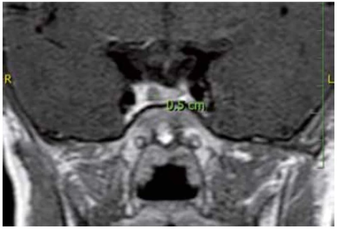 Magnetická rezonance hypofýzy u chlapce s mikroadenomem,
v tomto případě se somatotropinomem. V důsledku dlouhodobé
nadměrné koncentrace GH došlo k rozvoji vysokého vzrůstu,
což následně vedlo k tomuto nálezu na MR hypofýzy.