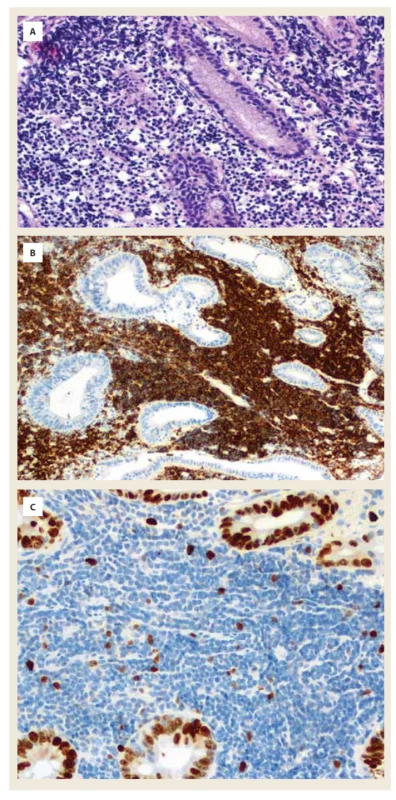 Histologické vyšetření bioptovaných
vzorků odebraných v místě stenózy
proximálního jejuna.<br>
A) Barvení hematoxylinem-eozinem;
zvětšení 200x: detail infiltrace střevní
sliznice denzní lymfoidní infiltrací.<br>
B) Barvení na CD20 (typické pro zralé
B-lymfocyty); zvětšení 200x: silná
membránová pozitivita CD20 v denzním
lymfoidním infiltrátu.<br>
C) Barvení na Ki67 (průkaz proliferační
aktivity buněk); zvětšení 200x: nízká
proliferační aktivita v denzním lymfoidním
infiltrátu, ve srovnání s okolní
střevní sliznicí s vysokou proliferační
aktivitou.<br>
Fig. 2. Histological examination of biopsied
samples taken at the site of proximal
jejunal stenosis.<br>
A) Hematoxylin-eosin staining; magnification 200x: 
detail of intestinal mucosal
infiltration by dense lymphoid
infiltration.<br>
B) Staining for CD20 (typical of mature
B cells); 200x magnification: strong
membrane positivity of CD20 in dense
lymphoid infiltrate.<br>
C) Staining for Ki67 (demonstration of
cell proliferative activity); 200x magnification:
low proliferative activity in the
dense lymphoid infiltrate, compared to
the surrounding intestinal mucosa with
high proliferative activity.