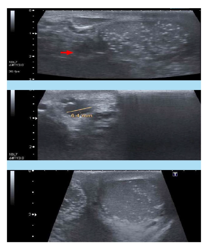 a, b, c. a) USG levého
varlete: testikulární mikrolitiáza,
tři spermatokély v nadvarleti
(červená šipka), b) USG nadvarlete
vlevo: detail spermatokél,
c) USG pravého varlete s mikrolitiázou,
bez jiné patologie (2020,
pacient č. 1)<br>
Fig. 3. a, b, c. a) Ultrasound
examination of the left testis:
testicular microlithiasis, three
spermatoceles of the epididymis
(red arrow), b) Ultrasound
examination of the left testis
and epididymis: detailed picture
of the spermatoceles, c) Ultrasound
examination of the right
testis with microlithiasis, without
other testicular patology (2020,
patient No 1)