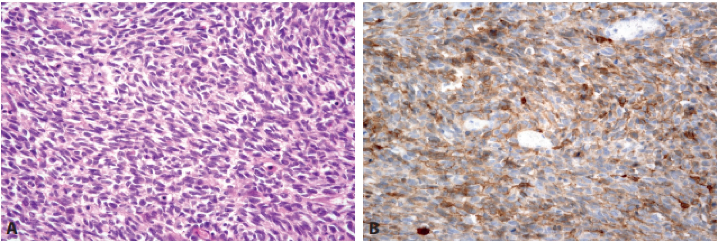 Sarkomatoidní karcinom. Sarkomatoidní karcinom tvořený vřetenitými i  epiteloidními buňkami může v  gastrointestinálním traktu
napodobovat GIST (A – HE, 200x), zejména když jeho buňky exprimují antigen CD117 (B – 200x).