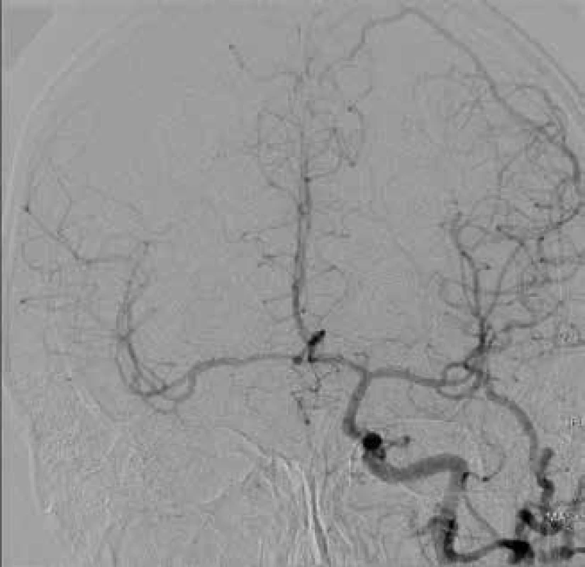 CT angiografie kontralaterální karotické arterie
s kompresí postižené tepny