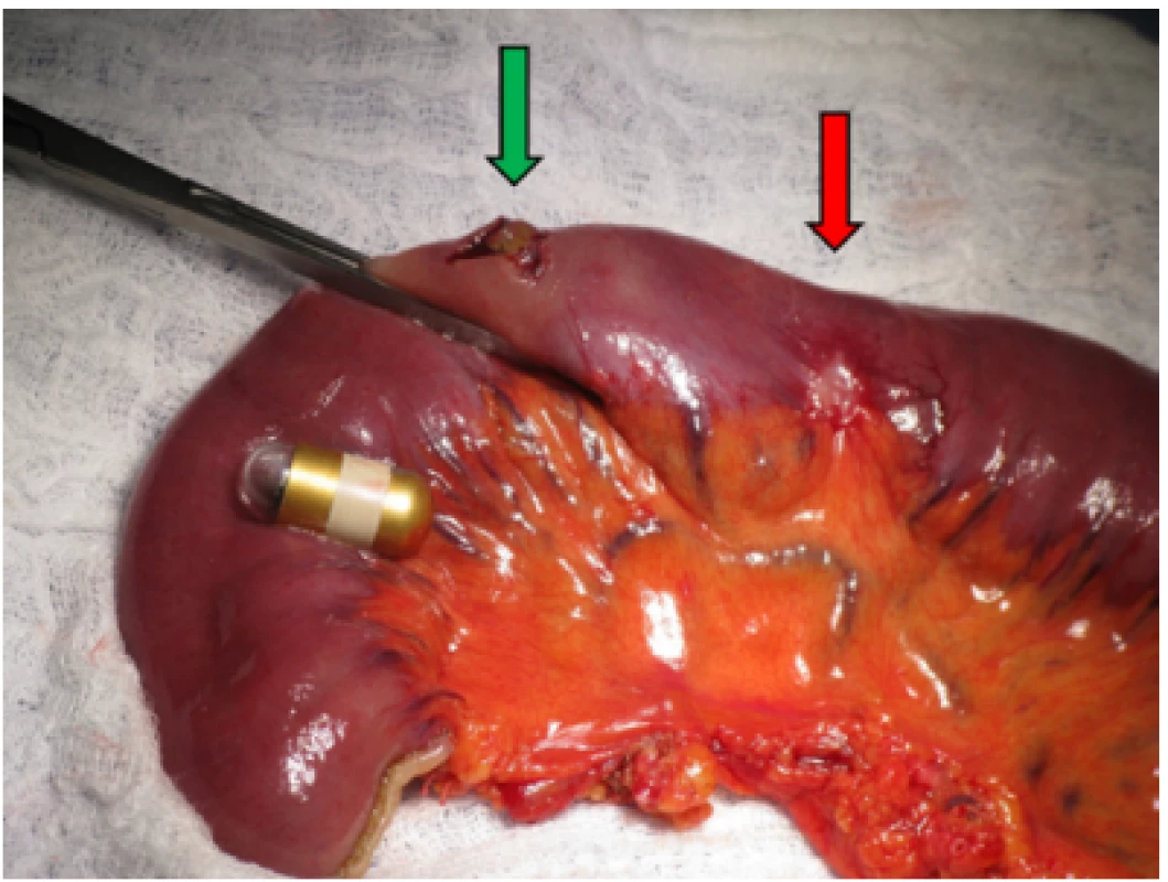 Peroperative view of infiltration of jejunum (red arrow) with the
lodged capsule which was extracted by enterotomy (green arrow)