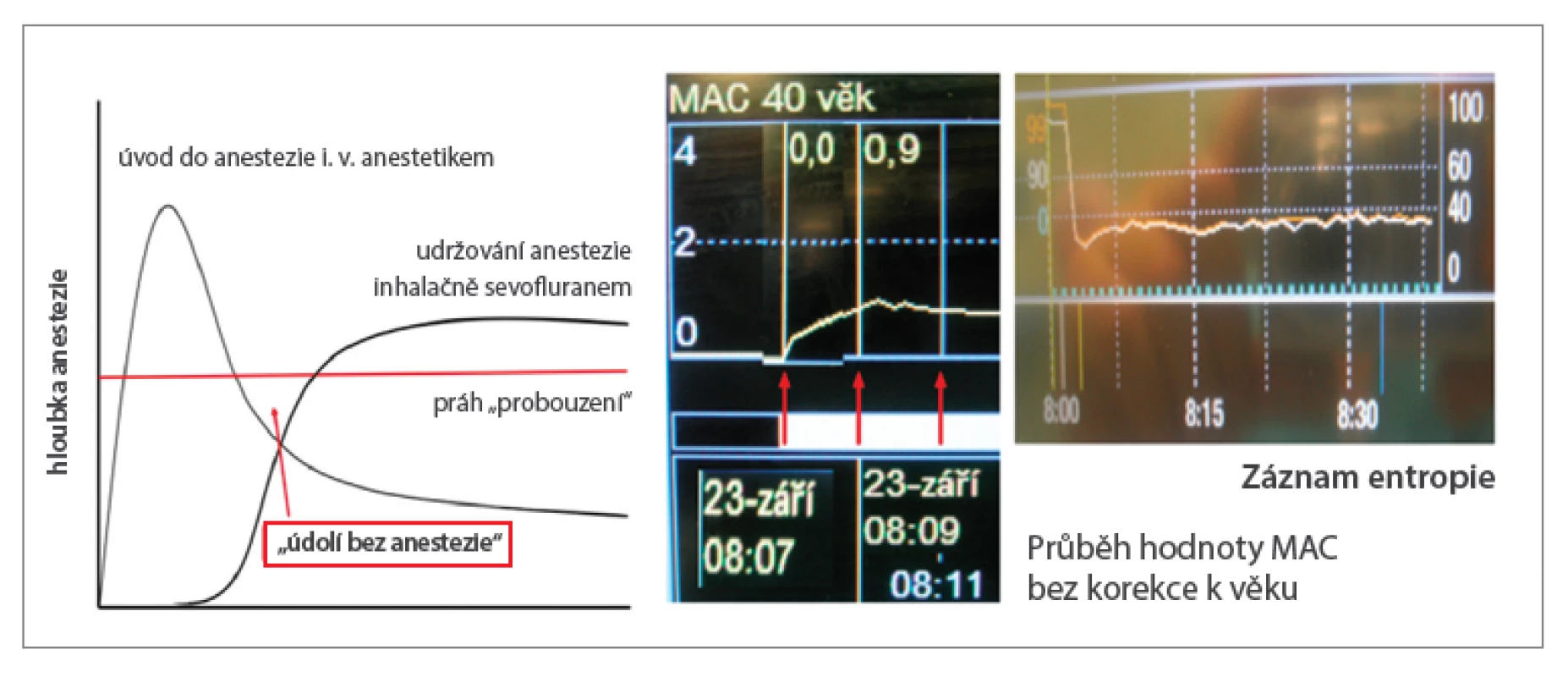 K „údolí bez anestezie“ nedochází ani při použití technik s nízkým FGF již od začátku anestezie,
jak dokumentuje skutečný záznam vzestupu MAC a průběhu entropie u 71letého pacienta s BMI 26,5 po
úvodu etomidátem a sufentanilem podstupujícího koronární revaskularizaci. Aplikace sevofluranu byla
zahájena bezprostředně po intubaci (rocuronium 1 mg/kg), odpařovač nastaven na 8 %, FGF 1 l/min,
FiO2 0,5. Hodnoty MAC 0,8 (chybně nekorigované podle věku) bylo dosaženo za 4 minuty).
