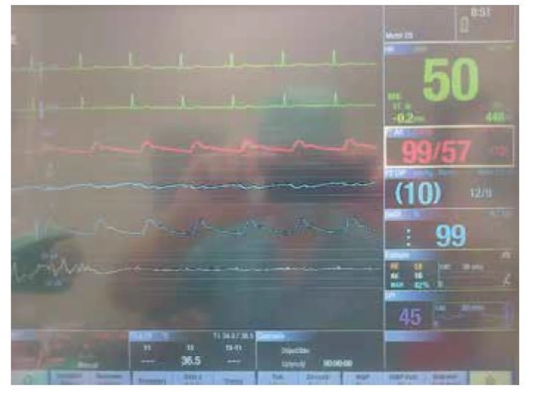 Šestá křivka shora na monitoru zobrazuje syrovou křivku EEG
snímanou monitorem Entropy Module. Vlevo je patrný burst, jenž přechází
do isoelektrické linie přerušované malými kmity, které odpovídají kmitům
R na EKG (kontaminace EEG křivky). Hodnoty RE a SE jsou nízké, tzn. korelují
s obrazem burst suppression a hodnotou BSR 42 %. Fialová hodnota 45 je
Surgical Plethysmography Index (koreluje s úrovní antinocicepce)