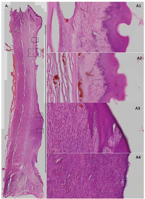 Bright-field microscopy of the post-CED defect in experimental animal T79<br>
The whole esophagus section in the post-CED defect site (A) which is delimited by the arrow (1.51x magnification). Details from
different parts of the CED defect with different grades of re-epithelization (A2>A1>A3>A4; A1, 3, 4=100x magnification; A2=50x
magnification).
