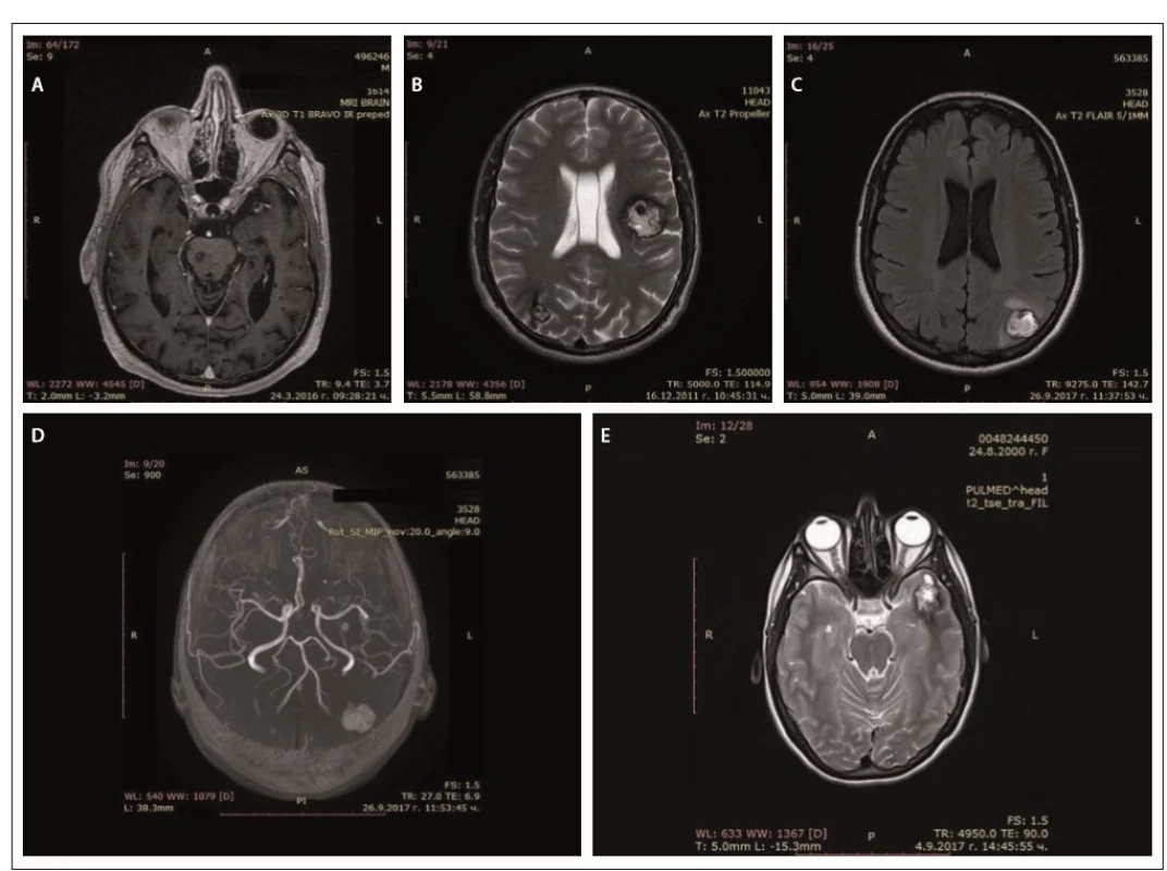 MRI of cerebral cavernous malformations – father (A), son (B), daughter (C, D), granddaughter (E).<br>
Obr. 2. MR cerebrálních kavernózních malformací – otec (A), syn (B), dcera (C, D), vnučka (E).